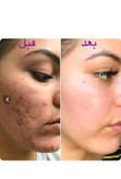 کرم 15 کاره ضدلک به شدت قوی اصل